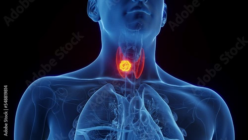 3d rendered medical animation of a neoplasm in a man's thyroid gland photo