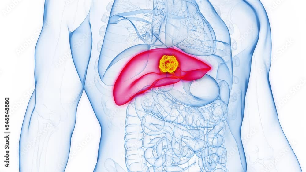 3d rendered medical animation of a malignant tumor in a man's liver