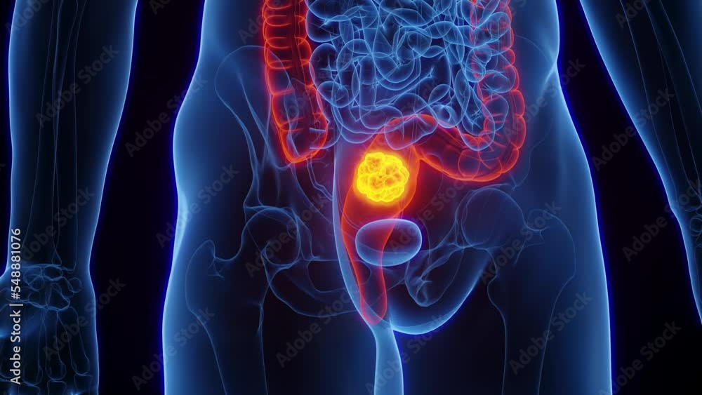 3D rendered medical animation of rectal cancer in a human male. 3D rendered medical animation of rectal cancer in a human male.