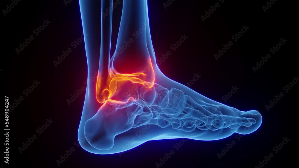 3D rendered Medical Animation of man's inflamed right ankle. 3D rendered Medical Animation of man's inflamed right ankle.