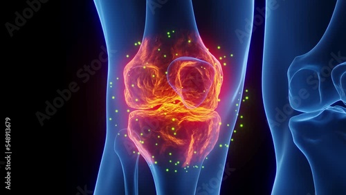 3D rendered Medical Animation of a man's right knee undergoing the healing process.