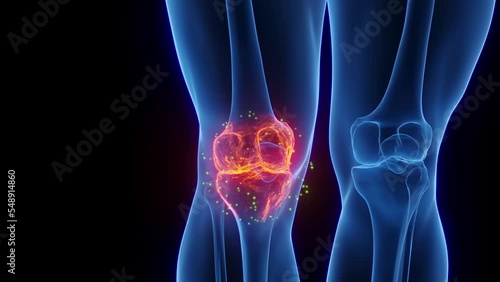 3D rendered Medical Animation of a man's inflamed right knee undergoing healing.