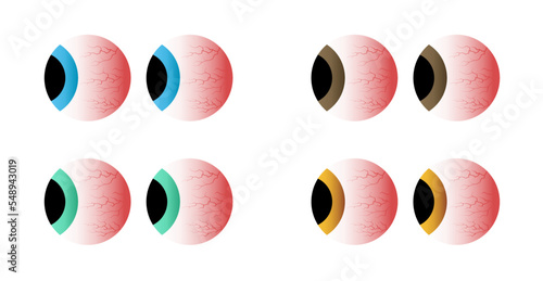 Red eyes side view set. Sick stress, sleep insomnia disorder, capillaries and pupils. Vector illustration.