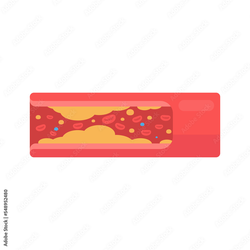 coronary arteries with accumulated fat in the body coronary arteries with accumulated fat in the body