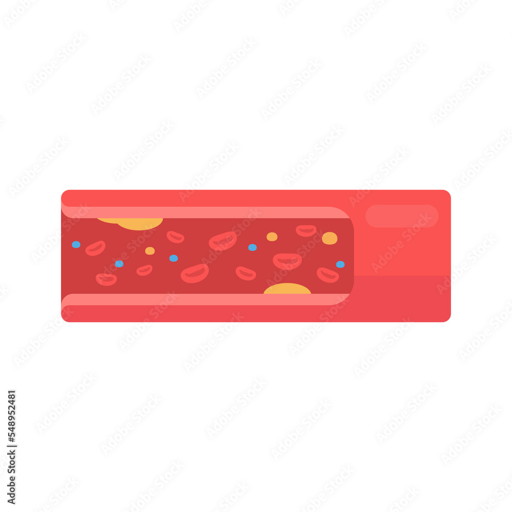 coronary arteries with accumulated fat in the body coronary arteries with accumulated fat in the body