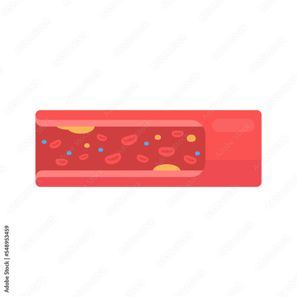 coronary arteries with accumulated fat in the body coronary arteries with accumulated fat in the body