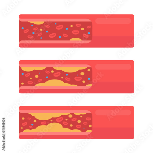 coronary arteries with accumulated fat in the body