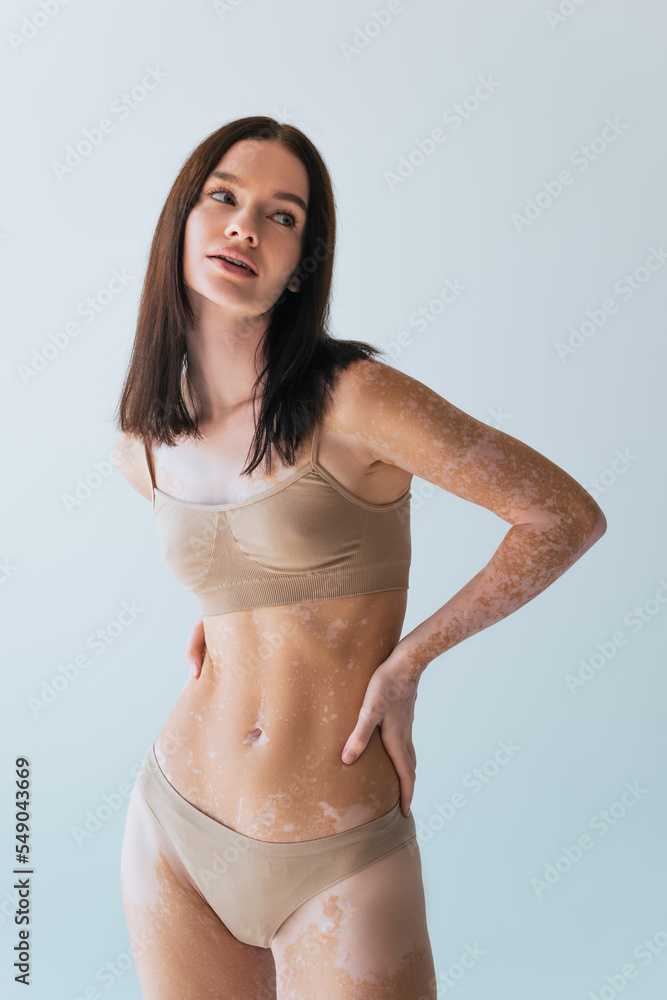 brunette model with vitiligo standing with hand on hip isolated on grey. brunette model with vitiligo standing with hand on hip isolated on grey.