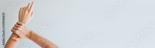 cropped view of woman with vitiligo chronical skin condition on hands isolated on grey, banner.