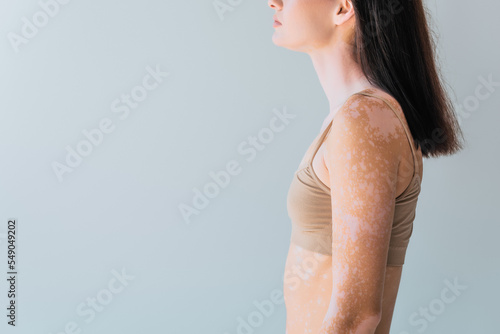 cropped view of brunette young woman with vitiligo standing isolated on grey.