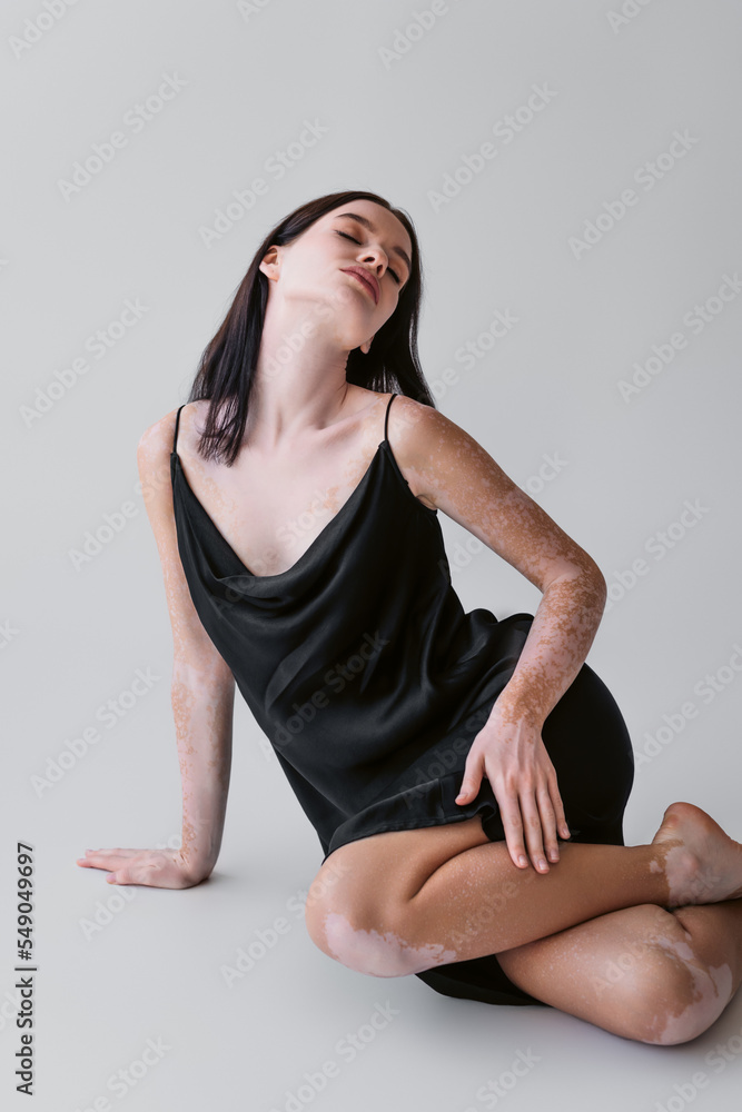Brunette woman with vitiligo posing in satin dress while sitting on grey background.
