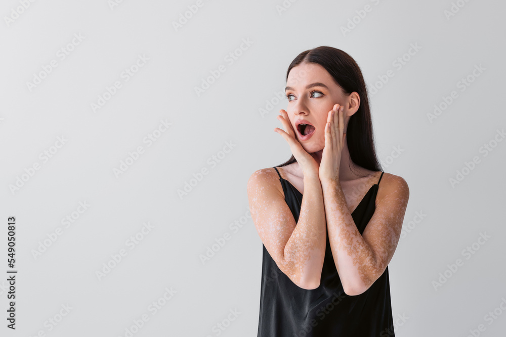 Shocked woman with vitiligo touching cheeks and looking away isolated on grey. Shocked woman with vitiligo touching cheeks and looking away isolated on grey.