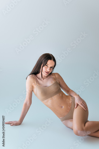 pretty young woman with vitiligo sitting in beige lingerie and looking at camera on grey.