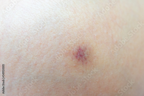 Close-up of a small bruise on a human body