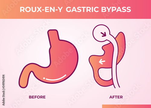 Roux-en-Y Gastric Bypass (RNY) Weight Loss Surgery vector illustration icon
