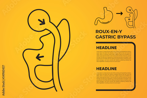 Roux-en-Y Gastric Bypass (RNY) Weight Loss Surgery vector illustration icon
