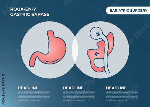 Roux-en-Y Gastric Bypass (RNY) Weight Loss Surgery vector illustration icon

