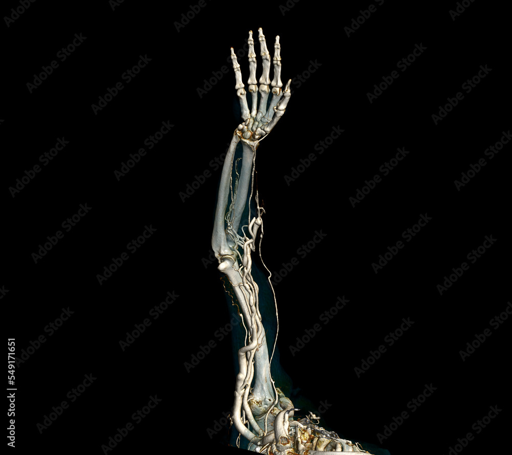 Brachial Arteries of the arm with Upper extremity Bone 3D rendering from CT Scanner. Brachial Arteries of the arm with Upper extremity Bone 3D rendering from CT Scanner.