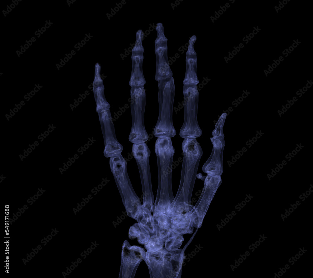 Hand 3D rendering for rheumatoid arthritis Concept. Hand 3D rendering for rheumatoid arthritis Concept.