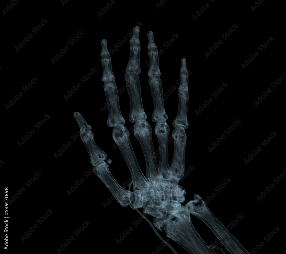 Hand 3D rendering for rheumatoid arthritis Concept. Hand 3D rendering for rheumatoid arthritis Concept.
