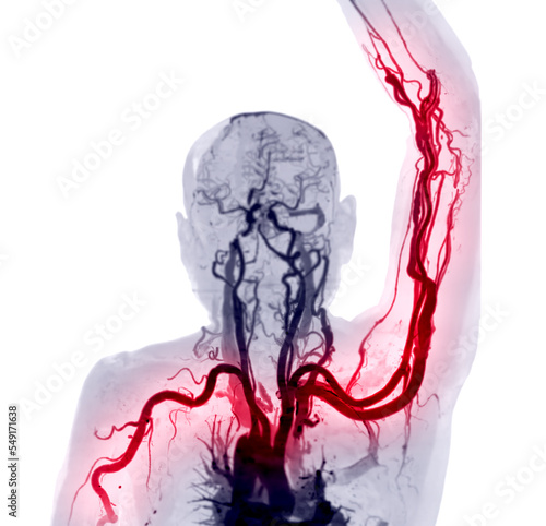 Obraz na plátně Brachial Arteries of the arm with Upper extremity Bone 3D rendering from CT Scanner