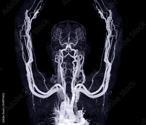 Tableau sur toile Brachial Arteries of the arm with Upper extremity Bone 3D rendering from CT Scanner