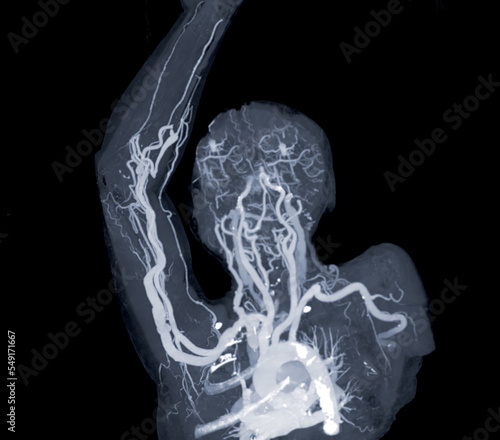 Brachial Arteries of the arm with Upper extremity Bone 3D rendering from CT Scanner. photo