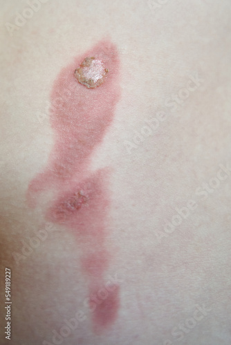 Image of skin with thermal skin burn after boiling water