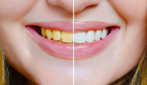close-up. a woman's smile with a comparison of whitened and yellow teeth.  © andrey