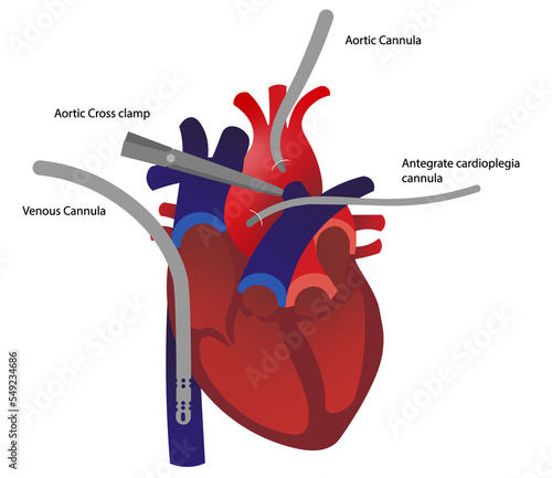 Cannulated Heart for a open chest cardiac surgery. Cardiopumonary bypass system cannula positioned