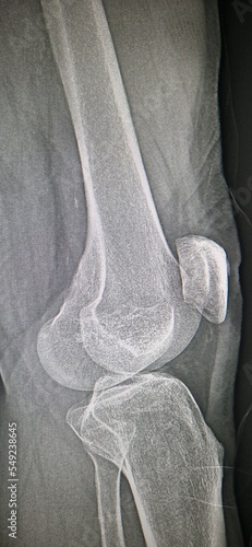 Rayos x o radiografía de rodilla don de sen las cabezas del fémur y tibia y la rotula.