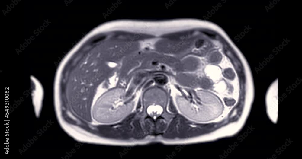 MRI Upper Abdomen for diagnosis Liver tumor or Hepatocellular carcinoma ( HCC ). MRI Upper Abdomen for diagnosis Liver tumor or Hepatocellular carcinoma ( HCC ).