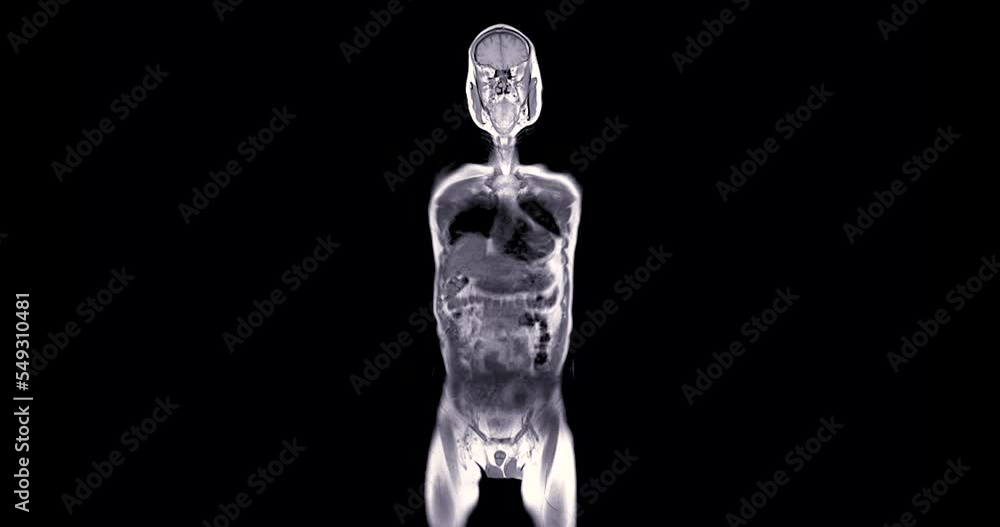 MRI whole body scan Coronal T1 by MRI scanner. Stock ビデオ Adobe Stock