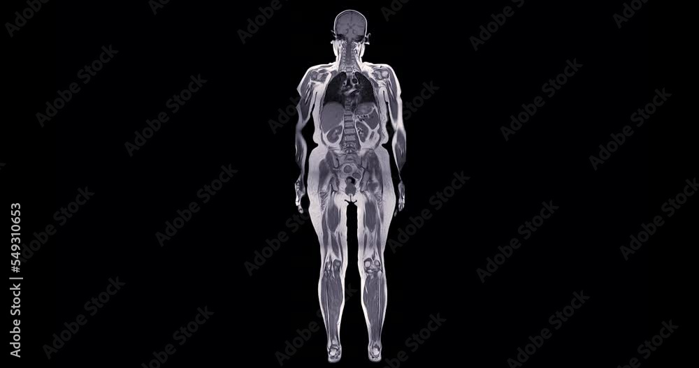 MRI whole body scan Coronal T1 by MRI scanner. MRI whole body scan Coronal T1 by MRI scanner.