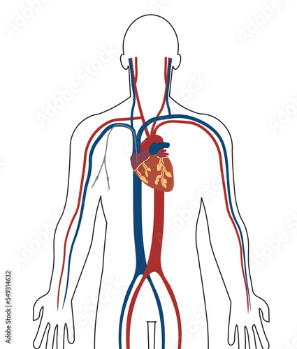 Central venous catheter illustration (CVC). Catheter positioned in the vein