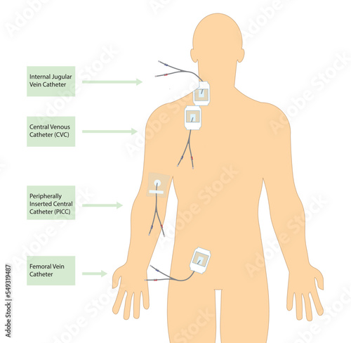 Catheter positioned in a men's body. Internal jugular vein , central venous (CVC), peripherally  inserted central (PICC) and femeroal vein catheter illustration
