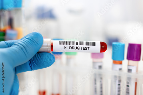 Doctor's hand with urinalysis and blood sample for drug test or alcohol in the laboratory. Hand doctor holding urine and blood tube test for analysis for doping or drugs