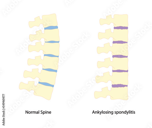 Ankylosing spondylitis illustration. Normal spine and spine with ankylosing spondylitis photo
