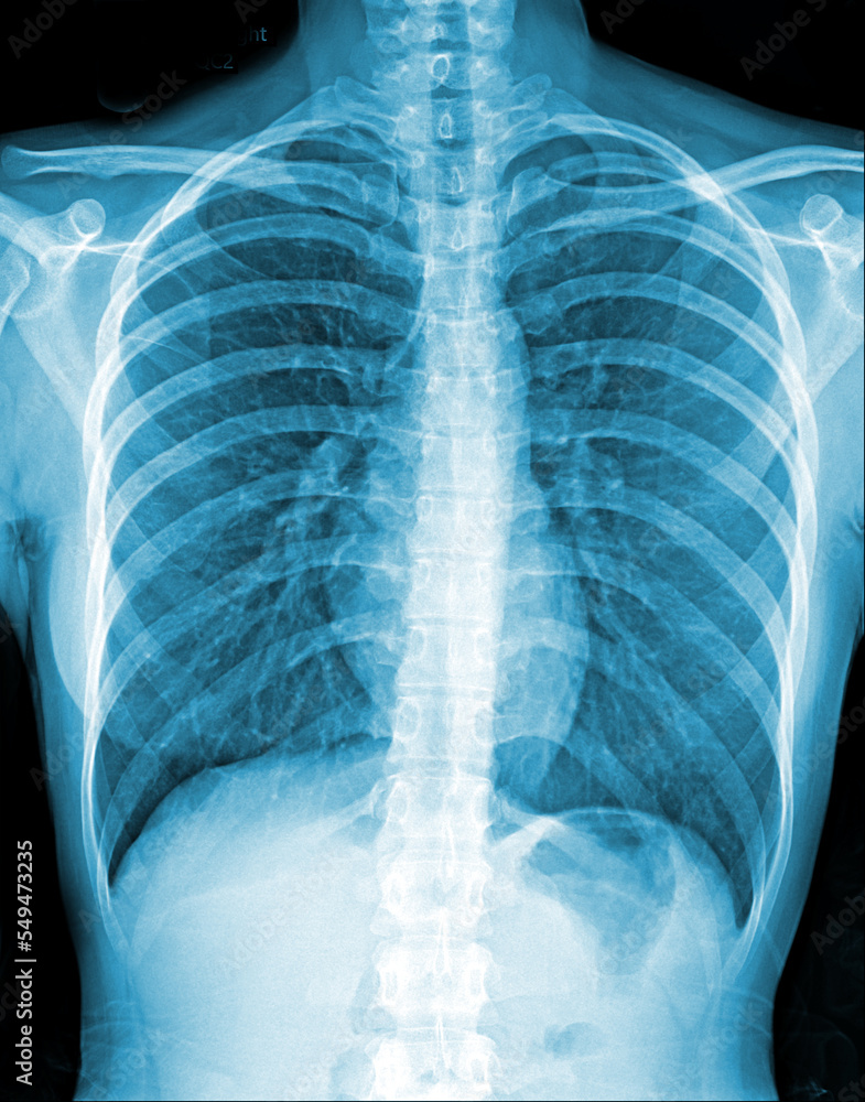 Chest x-ray film of patient for a medical Chest x-ray film of patient for a medical