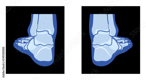 X-Ray Foot Legs Skeleton Human body Bones - malleolus, Phalanges adult people roentgen back view. Realistic flat blue color concept Vector illustration of medical anatomy isolated on black background