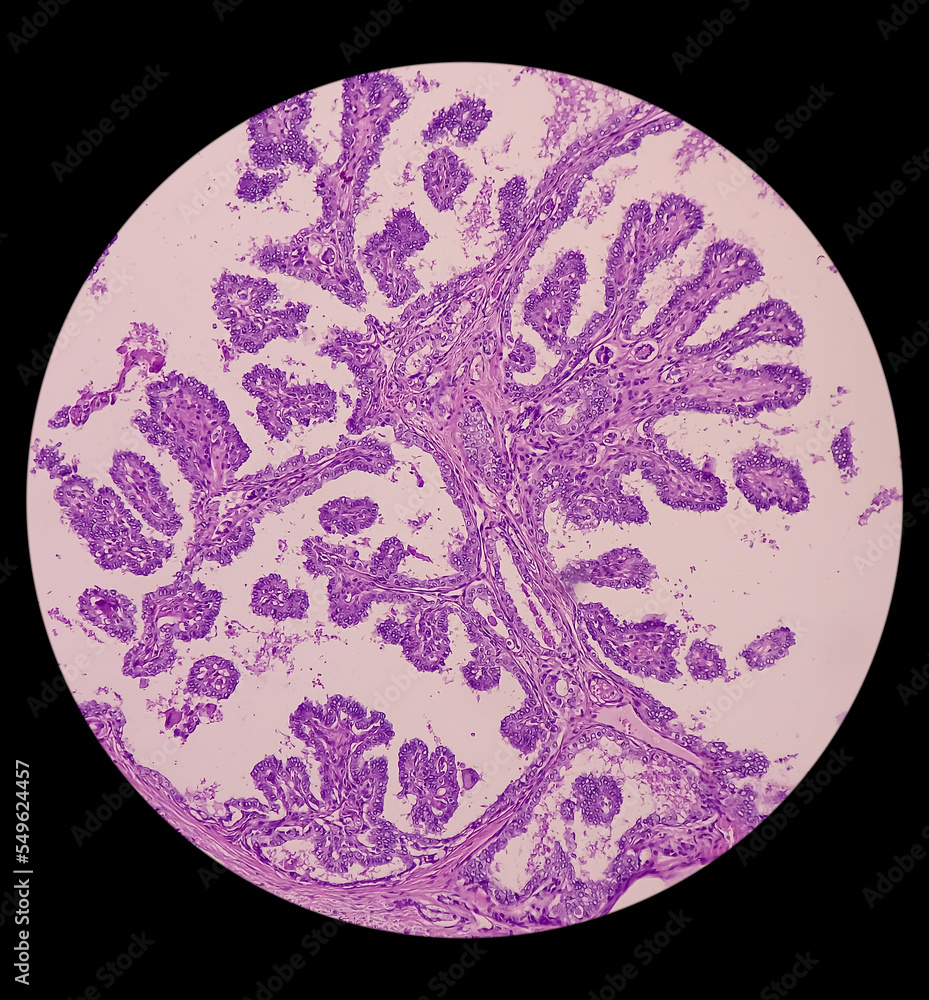 Intra abdominal mass with transverse colon(biopsy) Fibromatosis