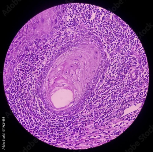 Finger biopsy, finger cancer, Invasive squamous cell carcinoma, grade-II. Show malignant neoplasm of atypical squamous epithelial cells. photo