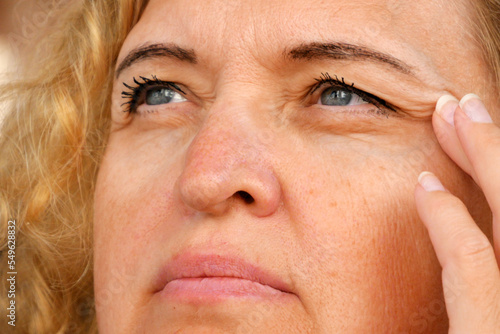 middle aged female's eye with drooping eyelid with patch for eyes. Ptosis is a drooping of the upper eyelid, lazy eye. Cosmetology and facial concept, first wrinkles photo