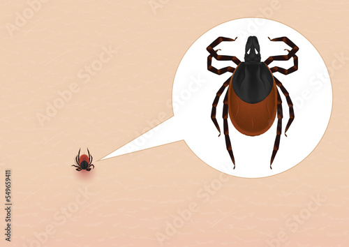The ixodic tick has stuck to the skin. An ixodic tick in magnification. The carrier of Lyme borreliosis and encephalitis.