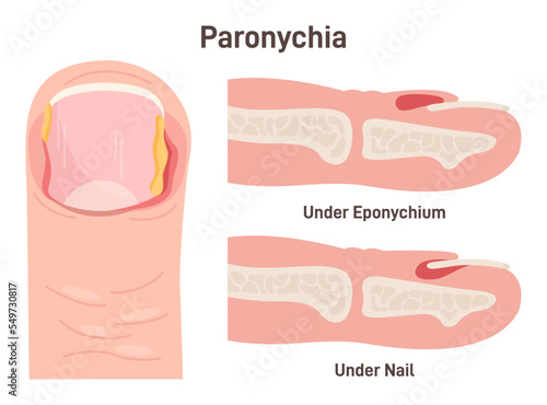Paronychia. Nail disease, inflammation of the skin around the nail.