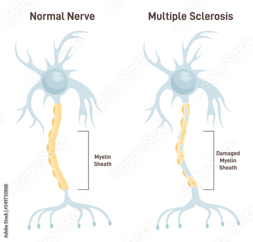 Multiple sclerosis. Autoimmune disease affecting the central nervous system.