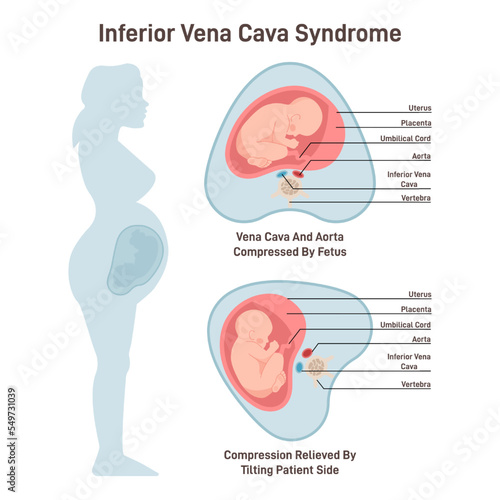Inferior vena cava syndrome. Pregnant woman has a compression photo