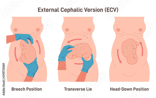 External cephalic version. Procedure that externally rotates the fetus