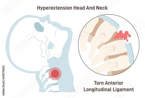 Neck hyperextension. Anterior longitudinal ligament torn. Spinal cord