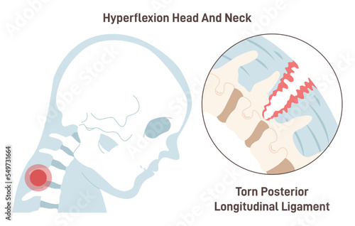 Neck hyperextension. Posterior longitudinal ligament torn. Spinal cord